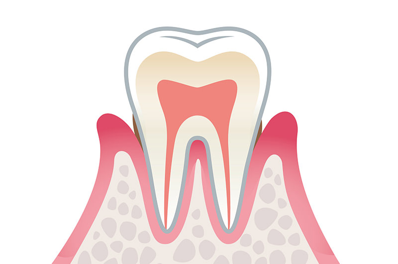 歯肉炎（初期の歯周病）