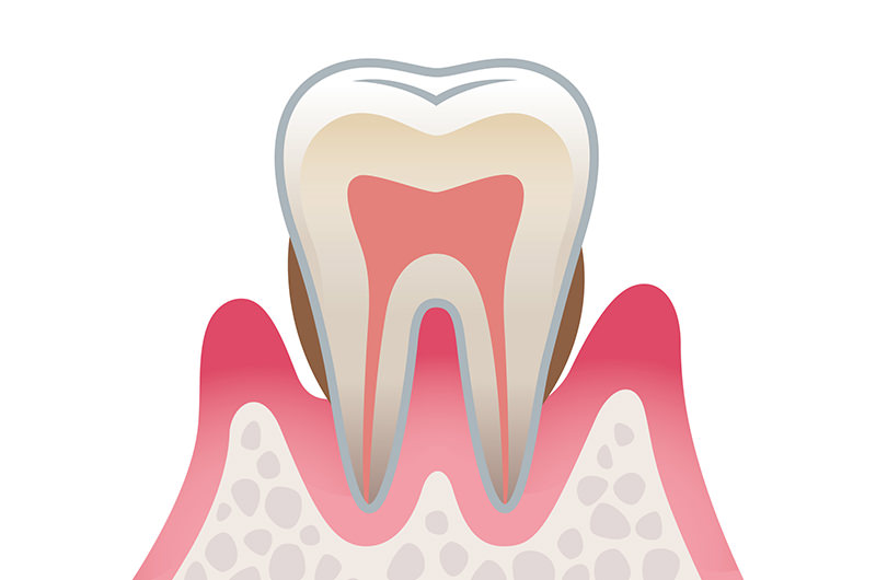 歯周炎（中度の歯周病）