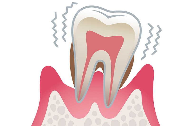 歯周炎・歯槽膿漏（重度の歯周病）
