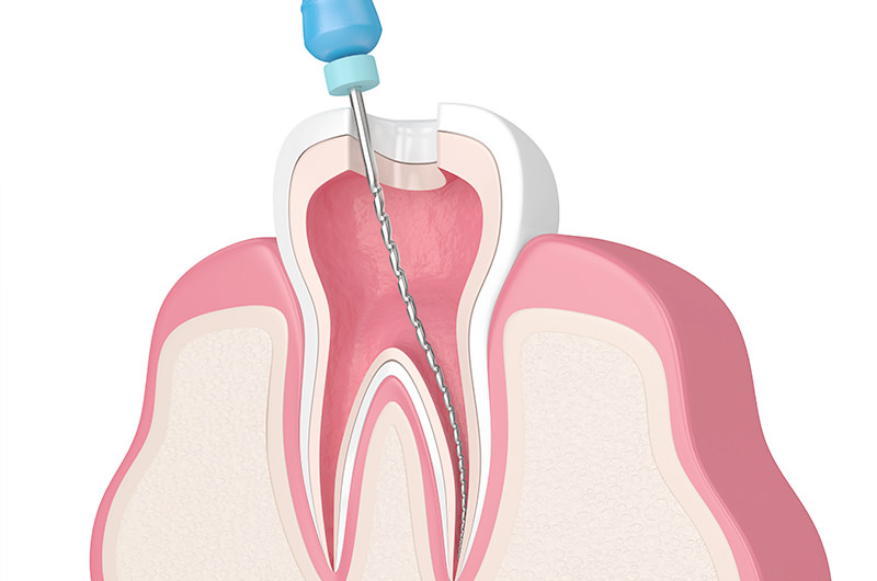 根管治療とは？