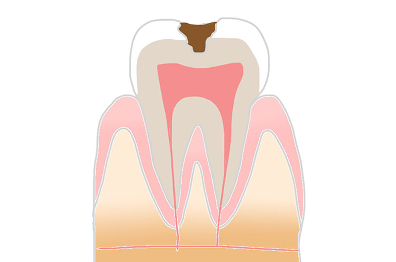 エナメル質のむし歯