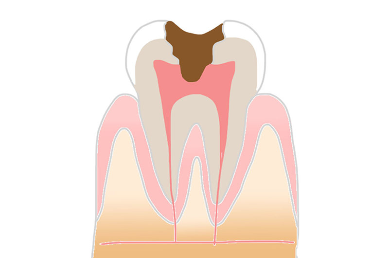 象牙質のむし歯
