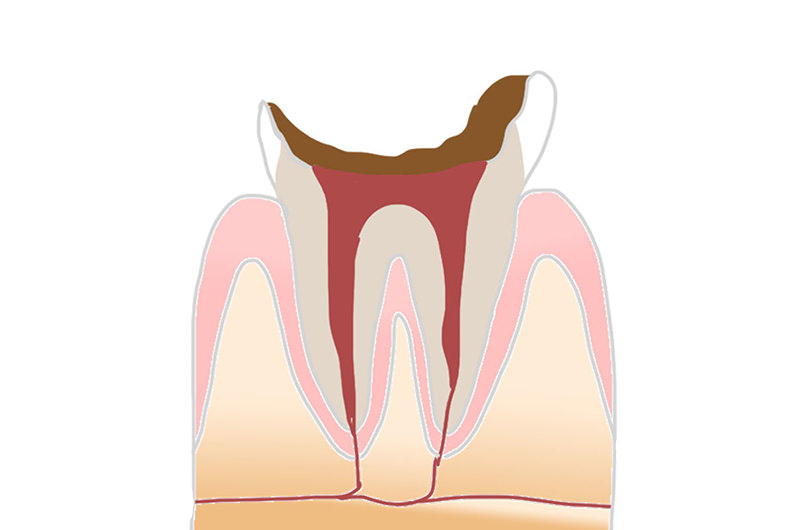 歯の神経に達したむし歯